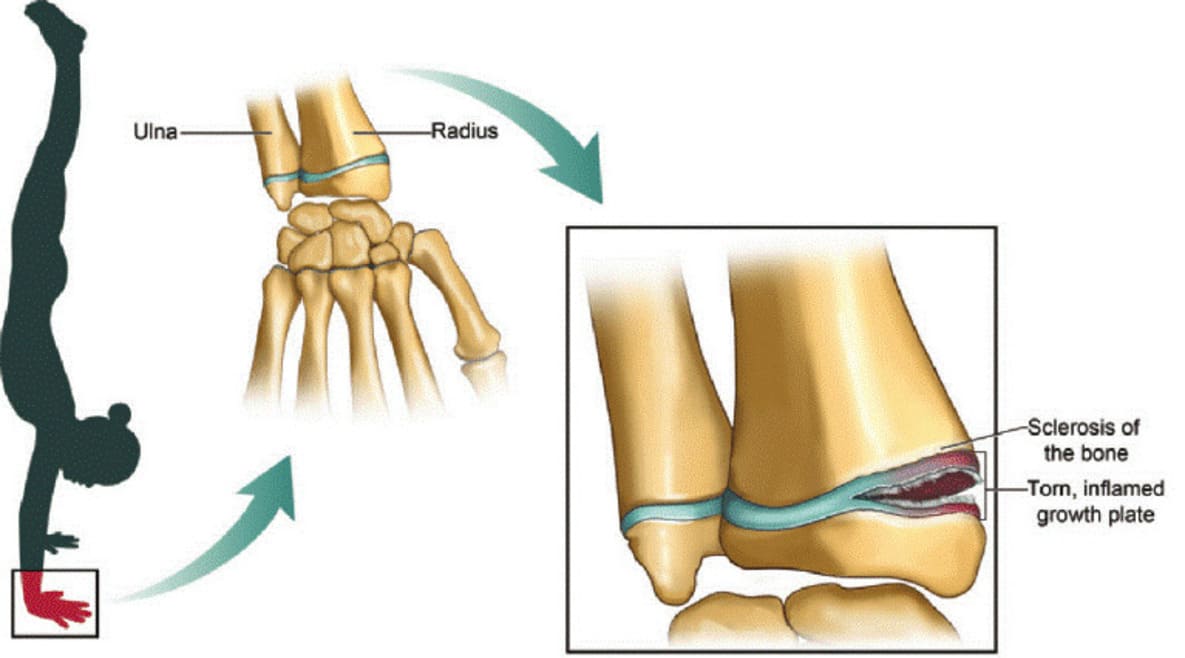 Bone Injuries for Gymnasts Bone Injuries for Gymnasts